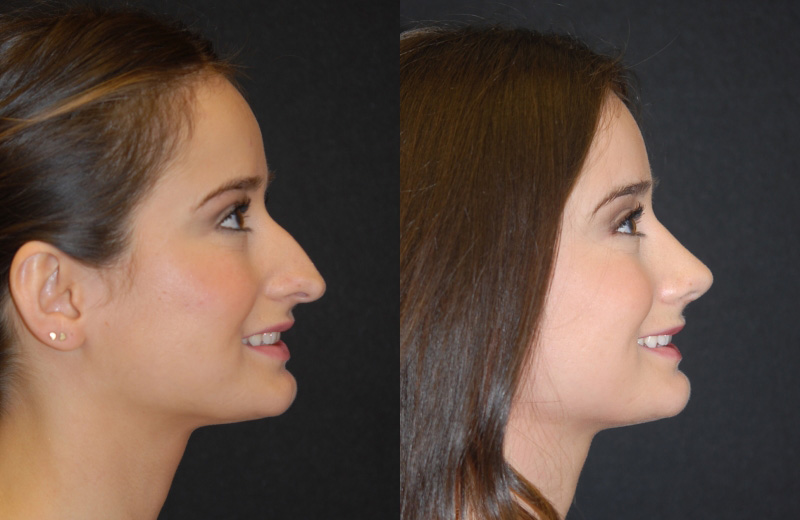 rhinoplasty